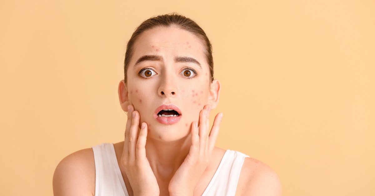 A worried woman with acne touching her face, symbolizing the question: Does drinking alcohol cause acne?