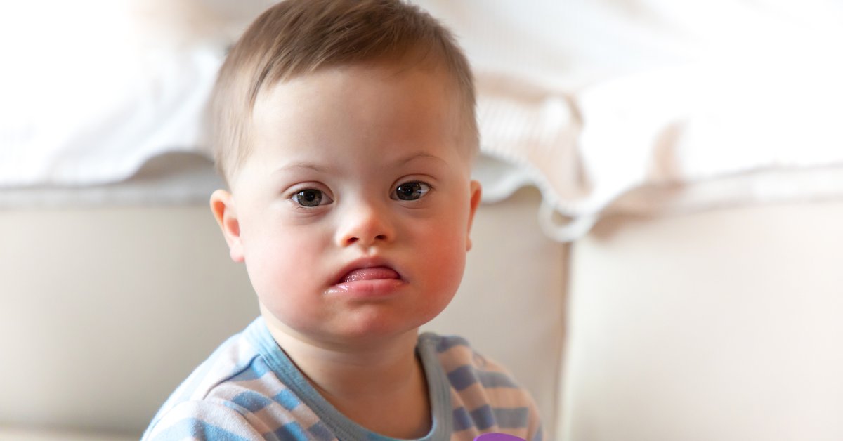 A young child with distinct facial features, representing the long-term effects of fetal alcohol syndrome in adulthood.